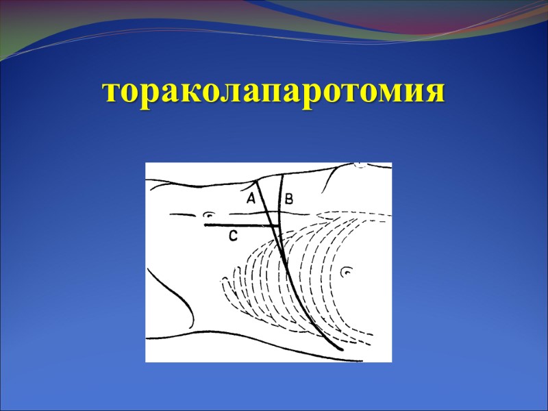 тораколапаротомия